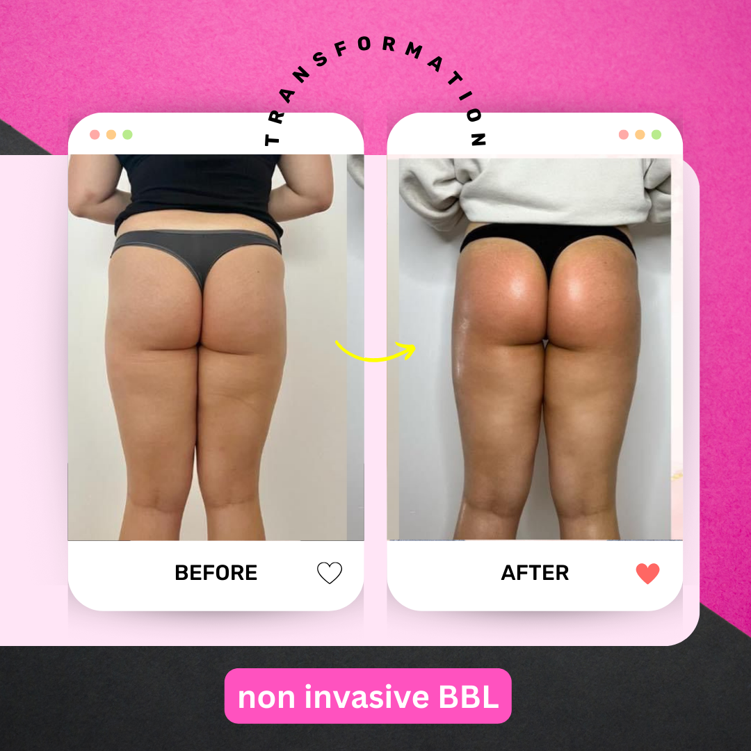 Body Sculpting by Gingerella Rox. Non invasive butt lift before & after photo