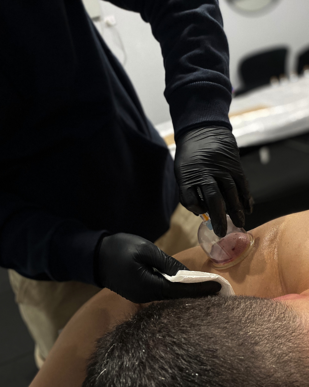 Hijama therapy practitioner demonstrating wet cupping techniques on a client