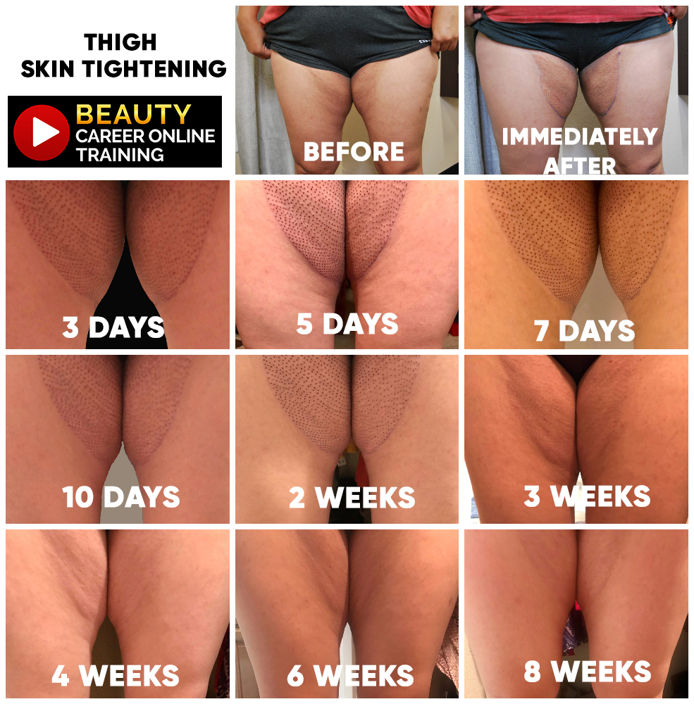 Thigh/Butt lift and cellulite reduction, cellulite, butt lift, butt lift without surgery, buttock lift, thigh, thighs, skin tightening, Fibroblast plasma, fibroblast plasma online training, plasma fibroblast online training, plasma pen, plasma pen online training, plasma pen training