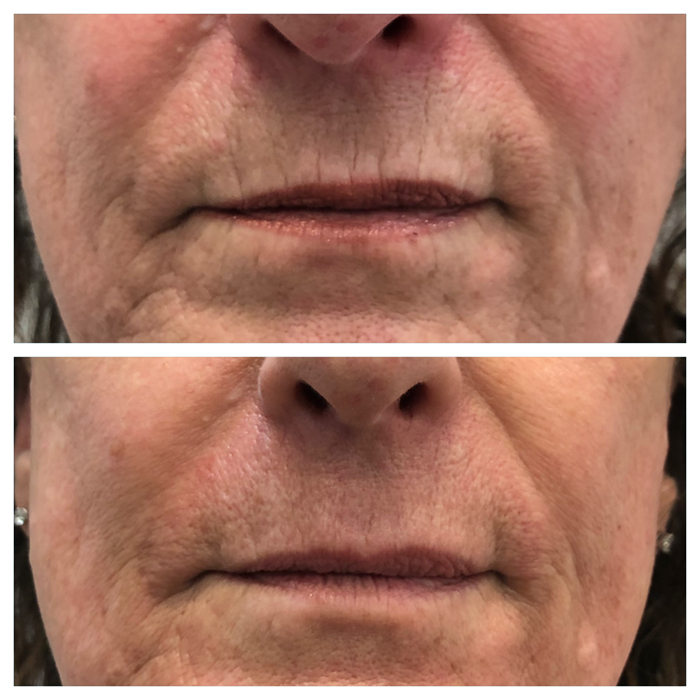mouth wrinkles, upper lip wrinkles, lower lip wrinkles, jowls 