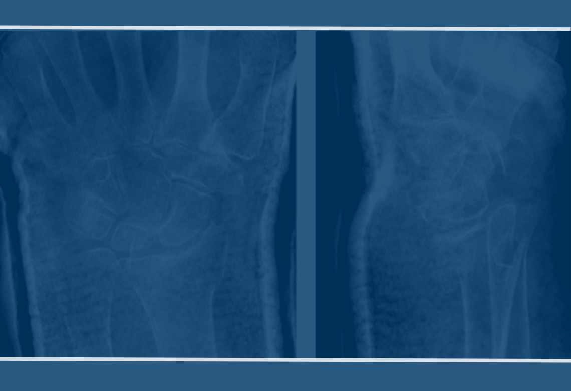 3D Classification and Treatment Methods for Dorsal and Palmar Distal Radius Fractures