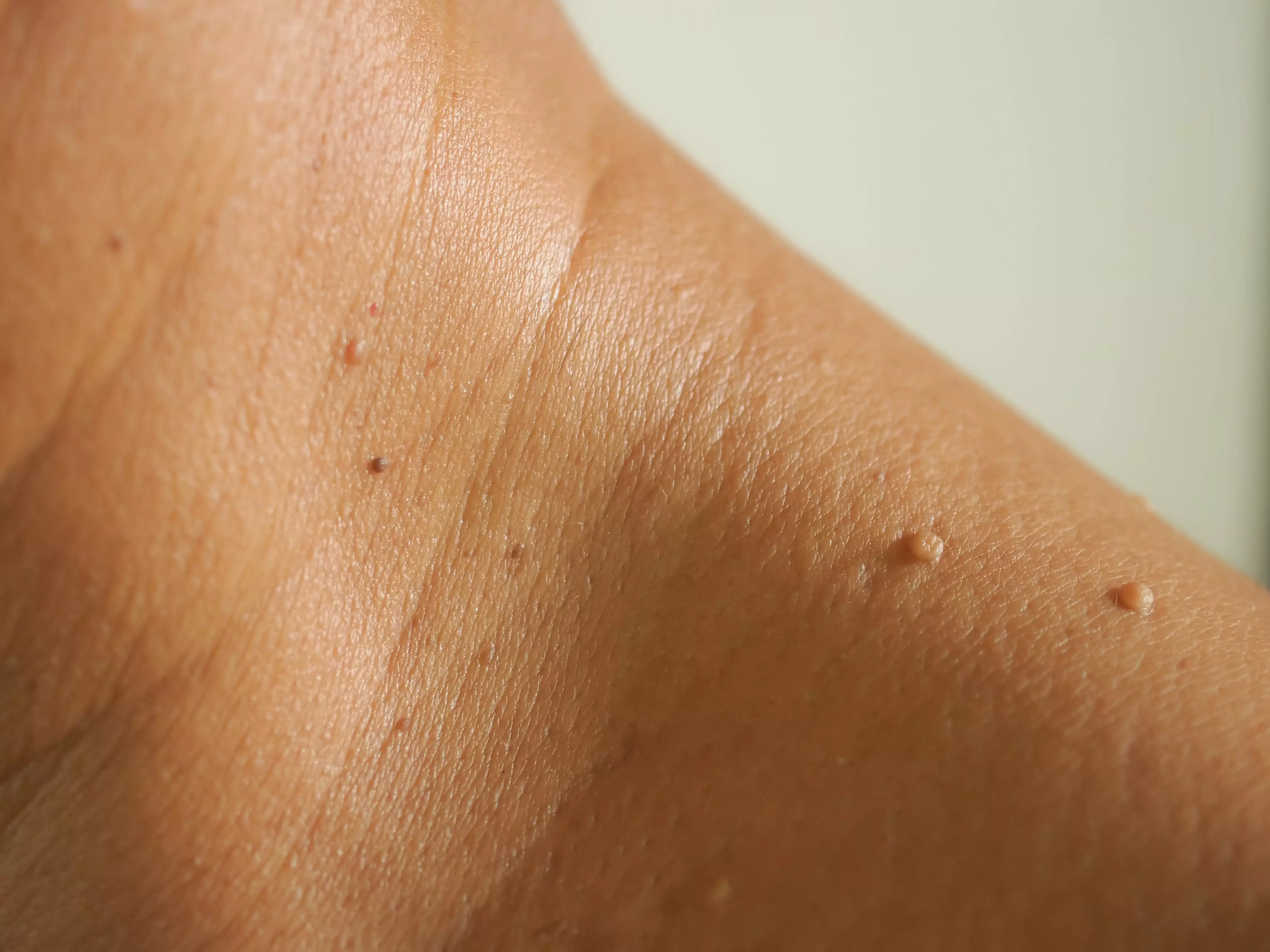 skin tag are painless, noncancerous growths on the skin, skin tag removal, 