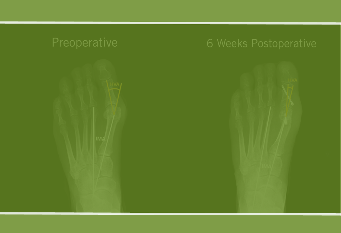 chevron-akin-osteotomy