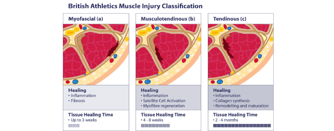 Renowned physio Mick Hughes goes through the British Athletics Muscle Injury Classification System in this scientific research review for latest hamstring research. 