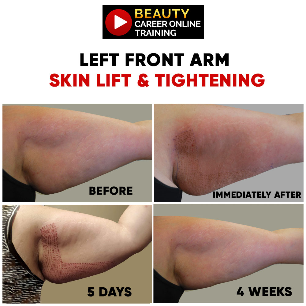 Arm tightening, arm weigh loss, weight loss, loose skin, saggy skin, stretch marks, post-partum, pregnancy, New mom, New dad, skin lift