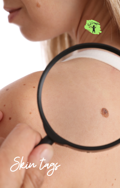 Skin tags