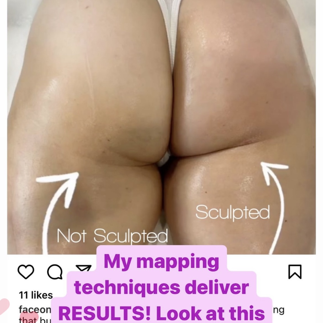 non-invasive butt lift result