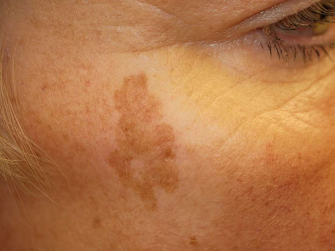 Erase Aging Hands Instantly! Remove Age spots, sun spots, brown spots