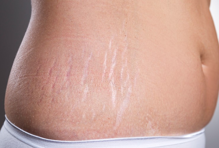 How to remove stretch marks for men and women 