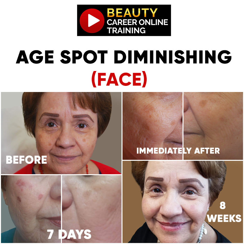 Remove age spots sunspots acne dark spots 