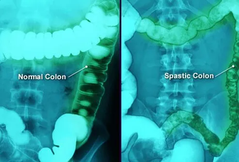 Normal and spastic colon comparisons.