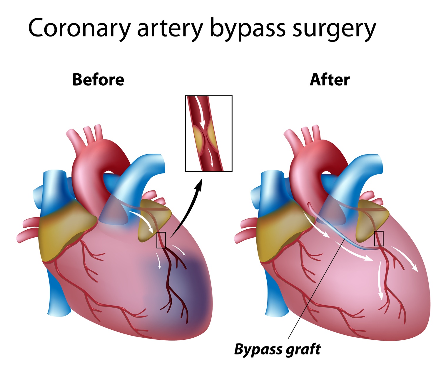 Coronary Artery Bypass Graft Cabg Freshrn