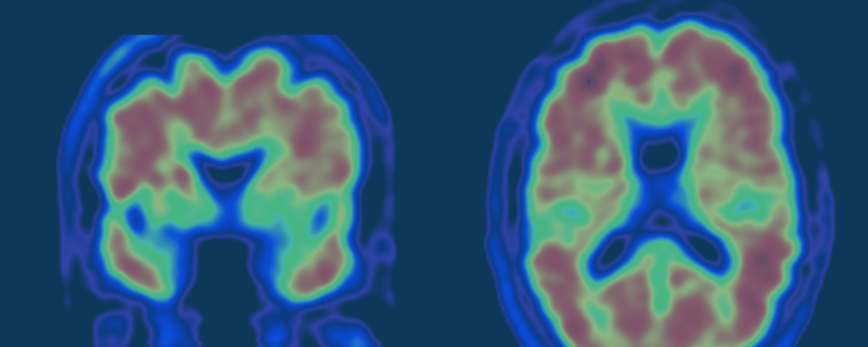 Chronic Infection and the Etiology of Dementia