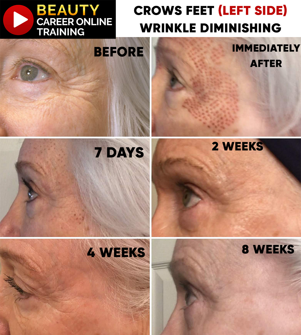 Crows Feet Wrinkle Lines Removing 
