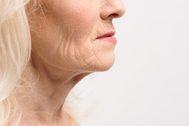 what are jowls, marionette lines, how to get rid of jowls, tighten jowls, ultherapy, plasma pen lift, plasma pen, firoblast plasma, plasma fibroblast, sagging jowls, jowls treatment, jowls face, sagging jowls botox, sagging jawline. jowls in 20s, best procedure for sagging jowls 2020, 2021, laser treatment for sagging jowls 