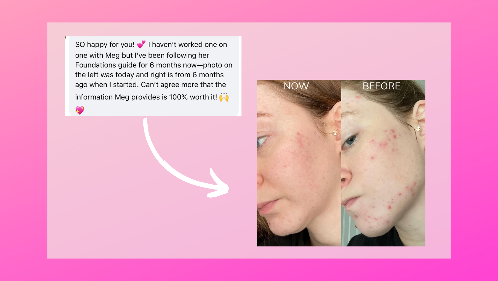 acne treatment testimonial