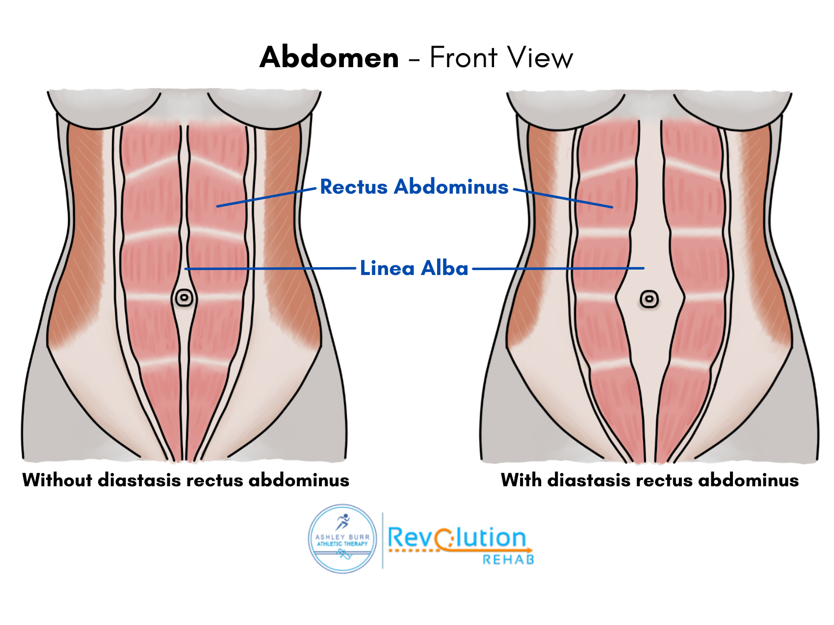 Diastasis Recti