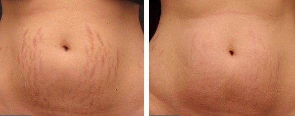 Before After Stretch Mark Removal, Before After Stretch mark diminishing, stretch mark after pregnancy's, sctrech mark after weight loss, weight lost, hormone changes, growth spurts 