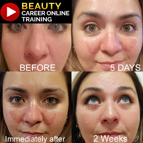 large pores, before and after pore, online pore training 