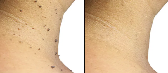 skin tags before and after, skin tag, skin tags, Remove skin tags, DIY skin tag removal, Mole removal, remove moles, Plasma pen skin tag, fibroblast plasma skin tag removal, plasma fibroblast skin tag removal