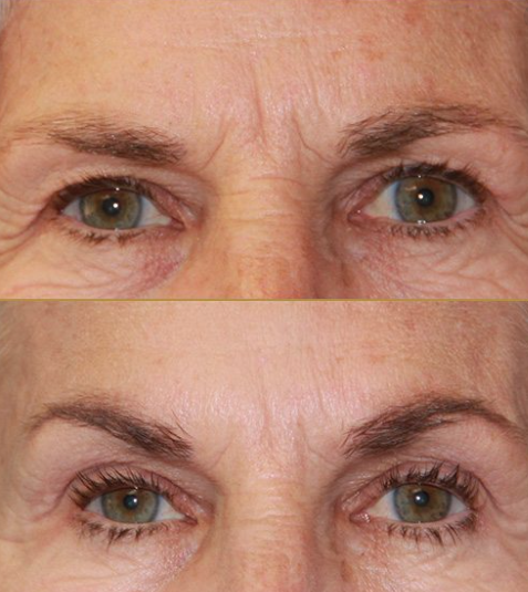 collagen production, forehead lines, forehead deep wrinkles, forehead wrinkles, furrow lines, furrow fine lines, furrow deep lines, fibroblast plasma online training, plasma fibroblast online training