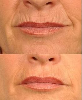 mouth wrinkles, smoker lines, marionette lines, smile lines, upper lip wrinkles, upper lip wrinkles home remedies, how to get rid of lip wrinkles, Lip wrinkles, smile lines, lip lines, upper lip wrinkles, lower lip wrinkles, deep lines, plasma lift, fiibroblast plasma, plasma fibroblast, plasma pen, plasma pen training, plasma pen online training 