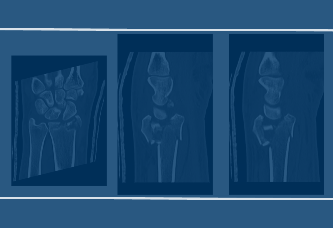 distal radius fractures