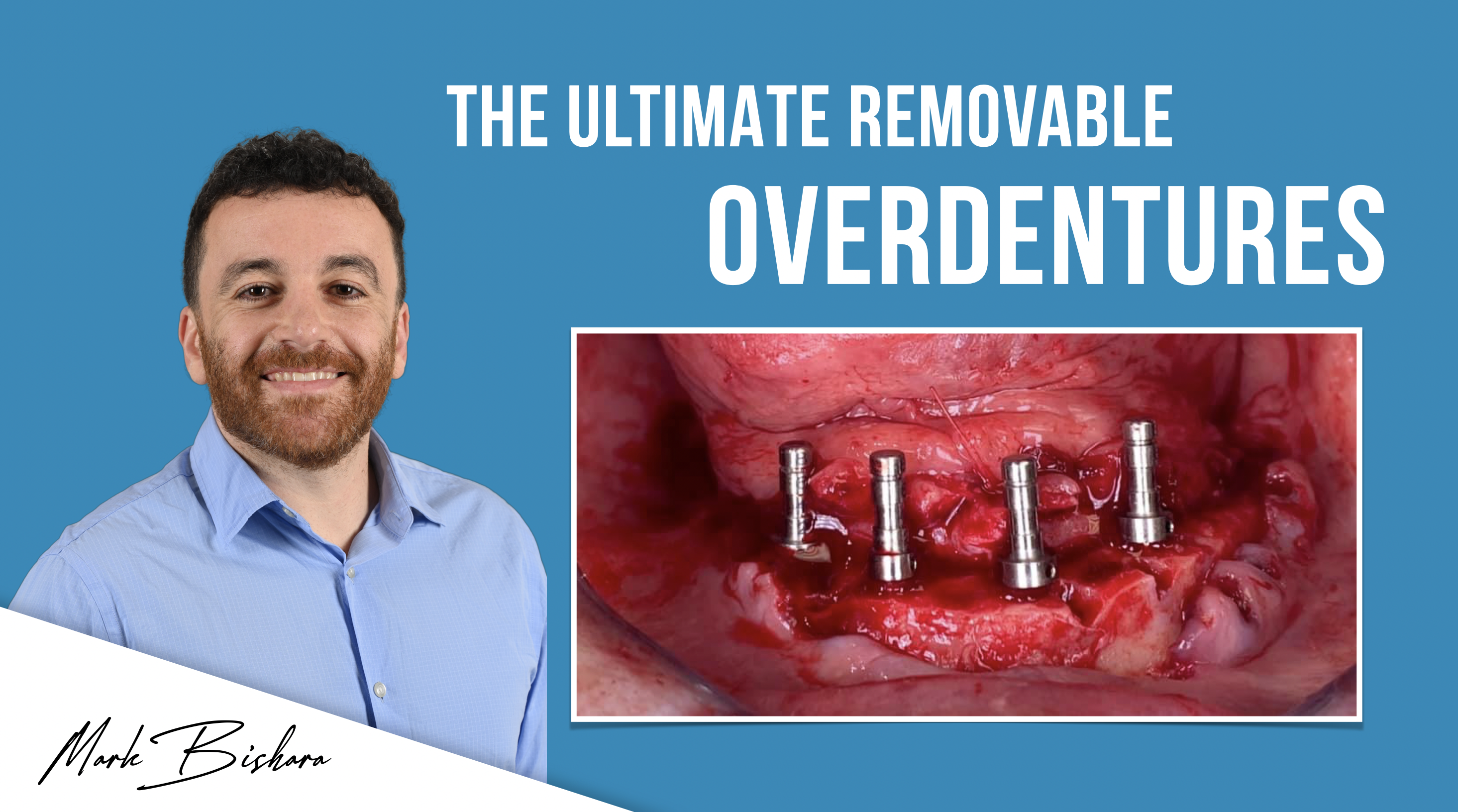Ultimate Removable Overdentures