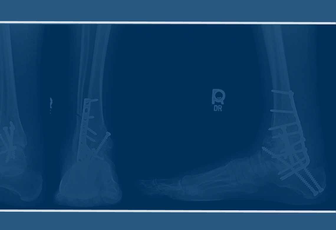 Ankle Arthrodesis (2018)