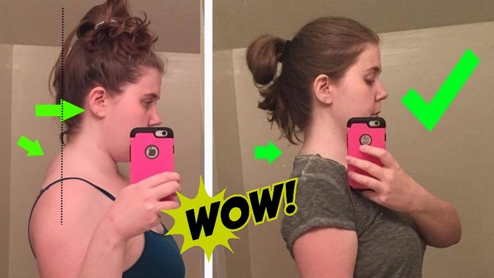 forward head posture - before and after