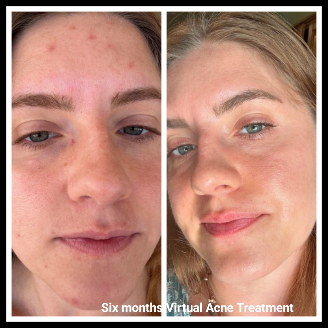 Virtual Acne Client