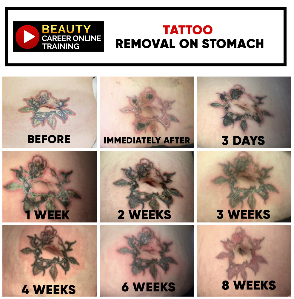Tattoo and Permanent Cosmetic Makeup Removal with Business Management