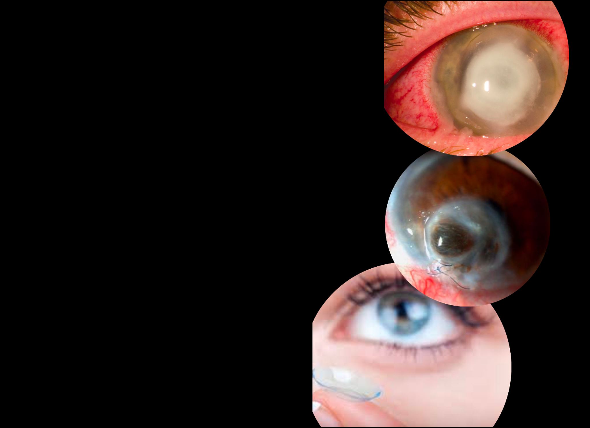 microbial keratitis