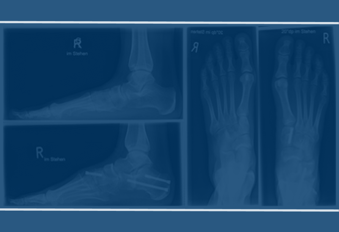 Posterior Tibial Tendon Dysfunction