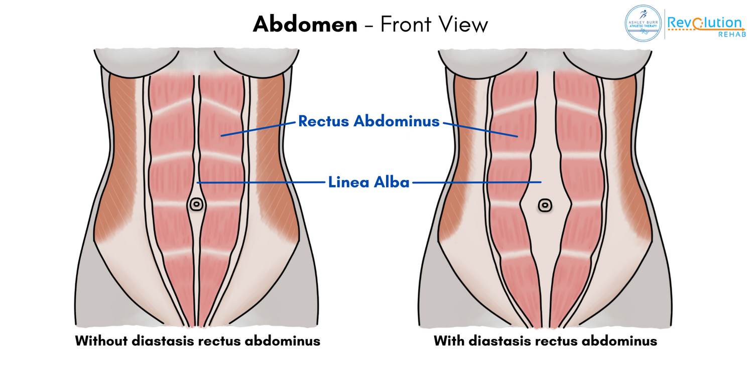 Diastasis