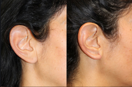 Ear Lobe Repair Treatment In Dlf Phase 4