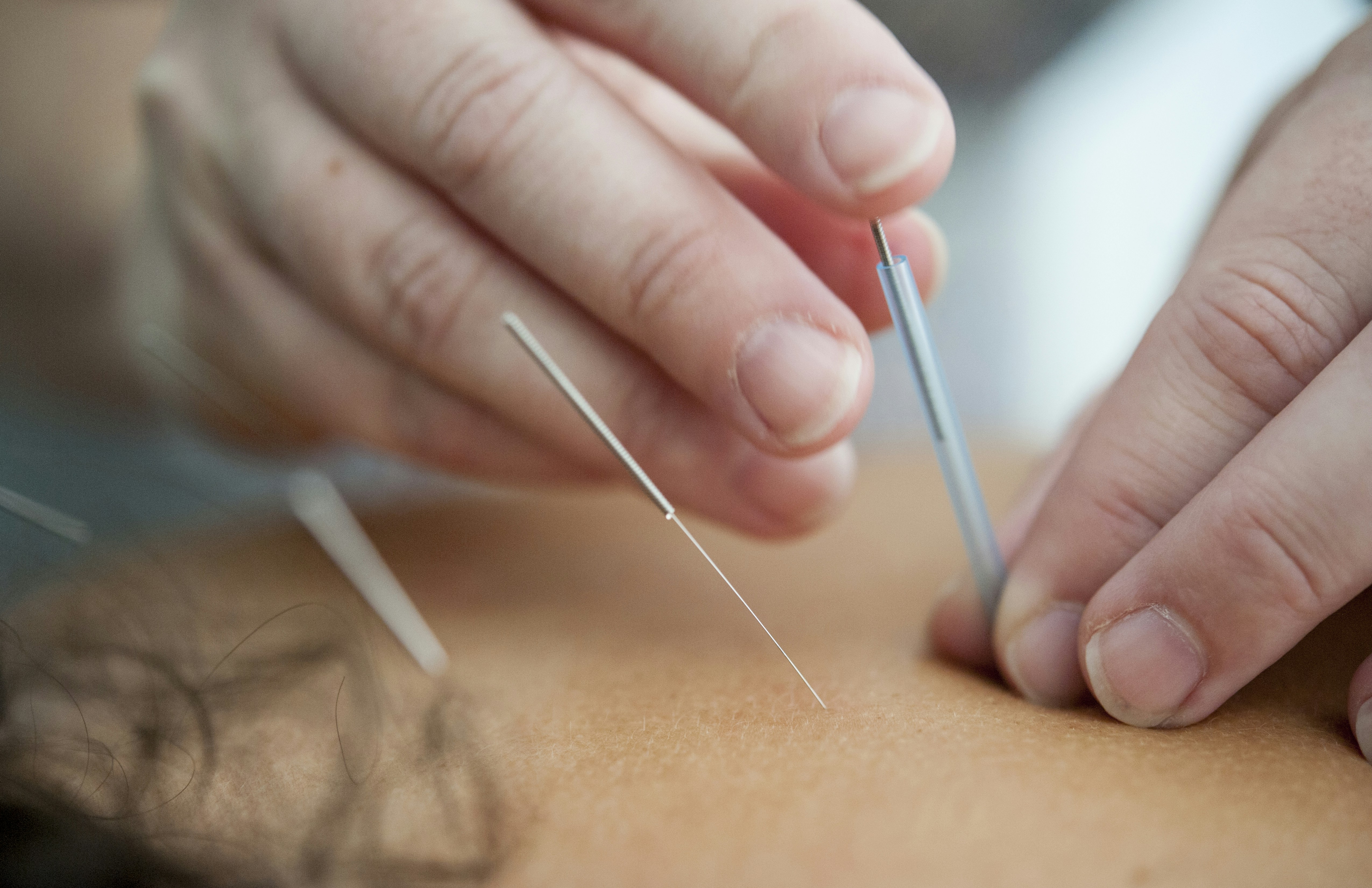 Acupuncture needle insertion into back