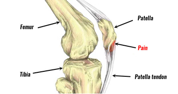 A diagram of the knee, covered in this research review about patellar tendinopathy and plyometrics.