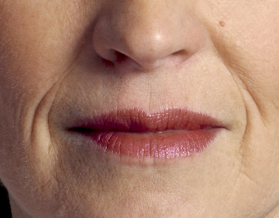 mouth wrinkles, upper lip wrinkles, lower lip wrinkles, jowls, smile lines, wrinkles