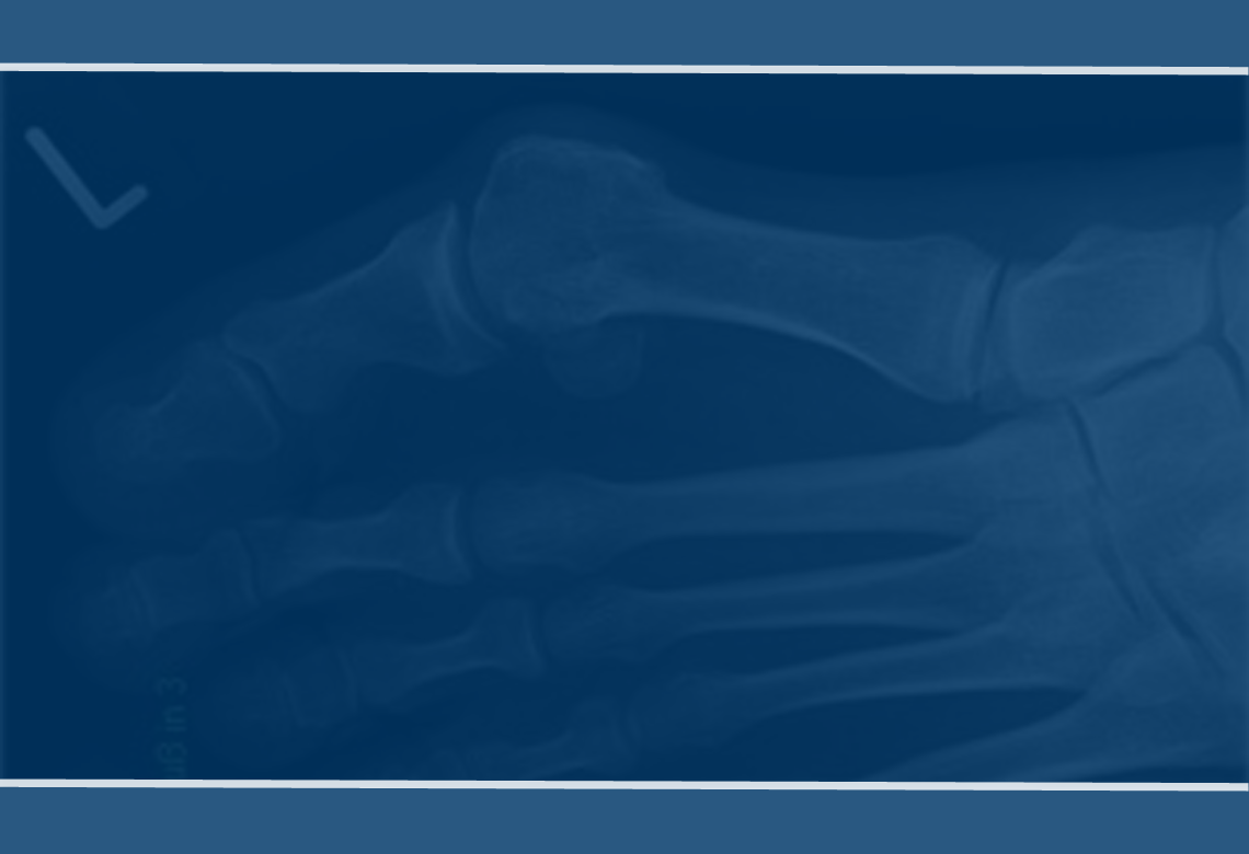 Rotational Instability of the TMT-1 Joint