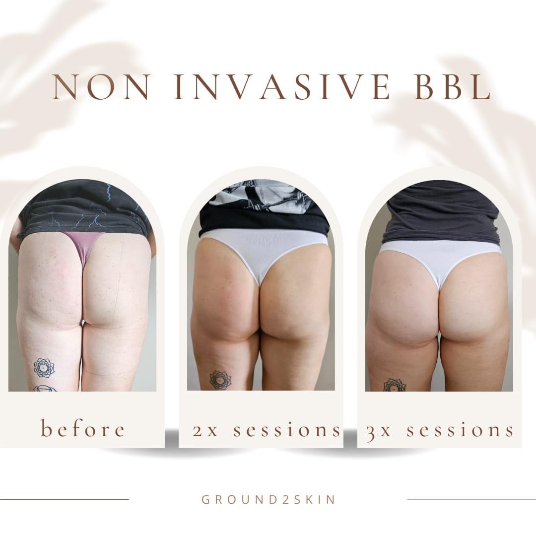 Body Sculpting by Gingerella Rox before & after pic non invasive Brazilian Butt lift