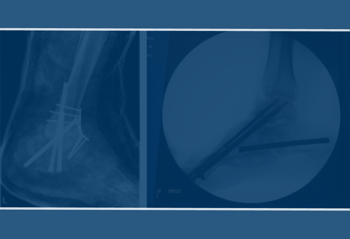 Complex Deformities of the Foot, New Solutions, Tipps and Tricks