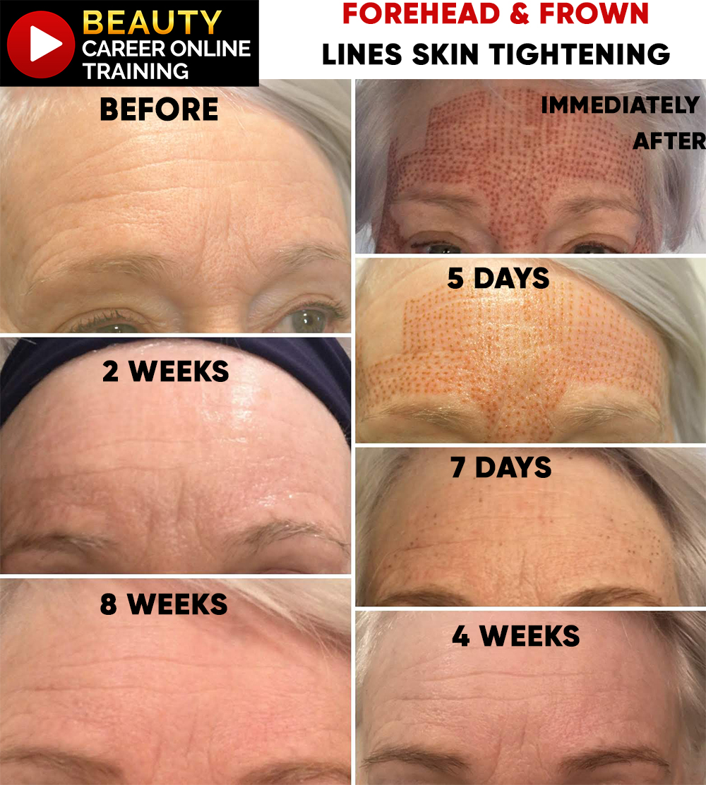 collagen production, forehead lines, forehead deep wrinkles, forehead wrinkles, furrow lines, furrow fine lines, furrow deep lines, fibroblast plasma online training, plasma fibroblast online training