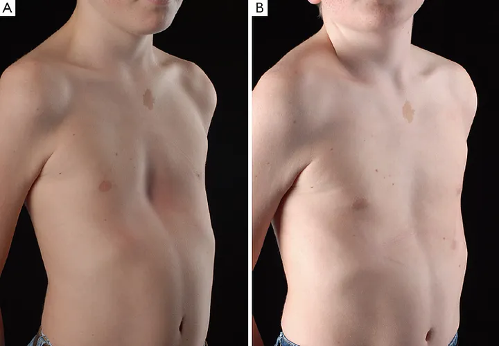 Nuss procedure results