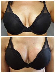 Chest lift, cleavage wrinkles, breast lift, chest wrinkles
