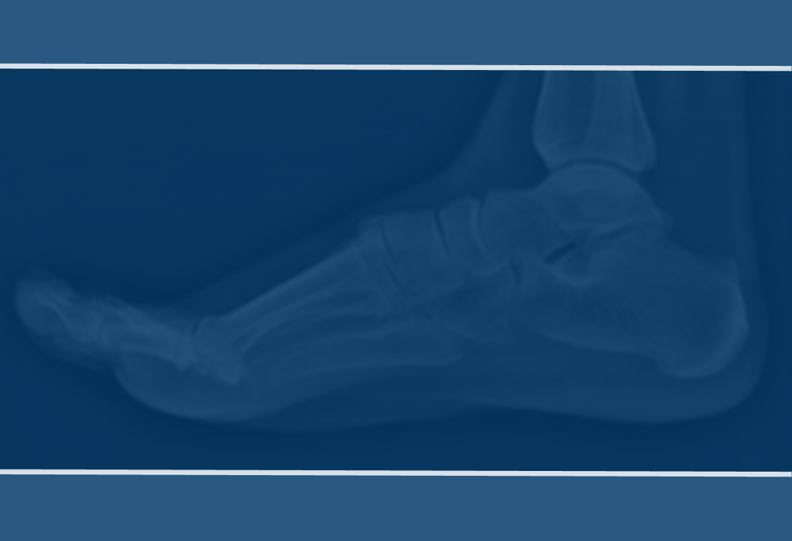 Calcaneal Fractures