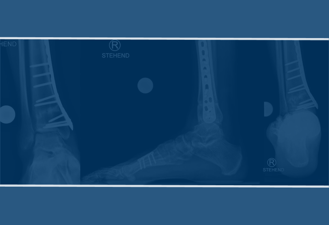 Arthroscopic Cartilage Repair