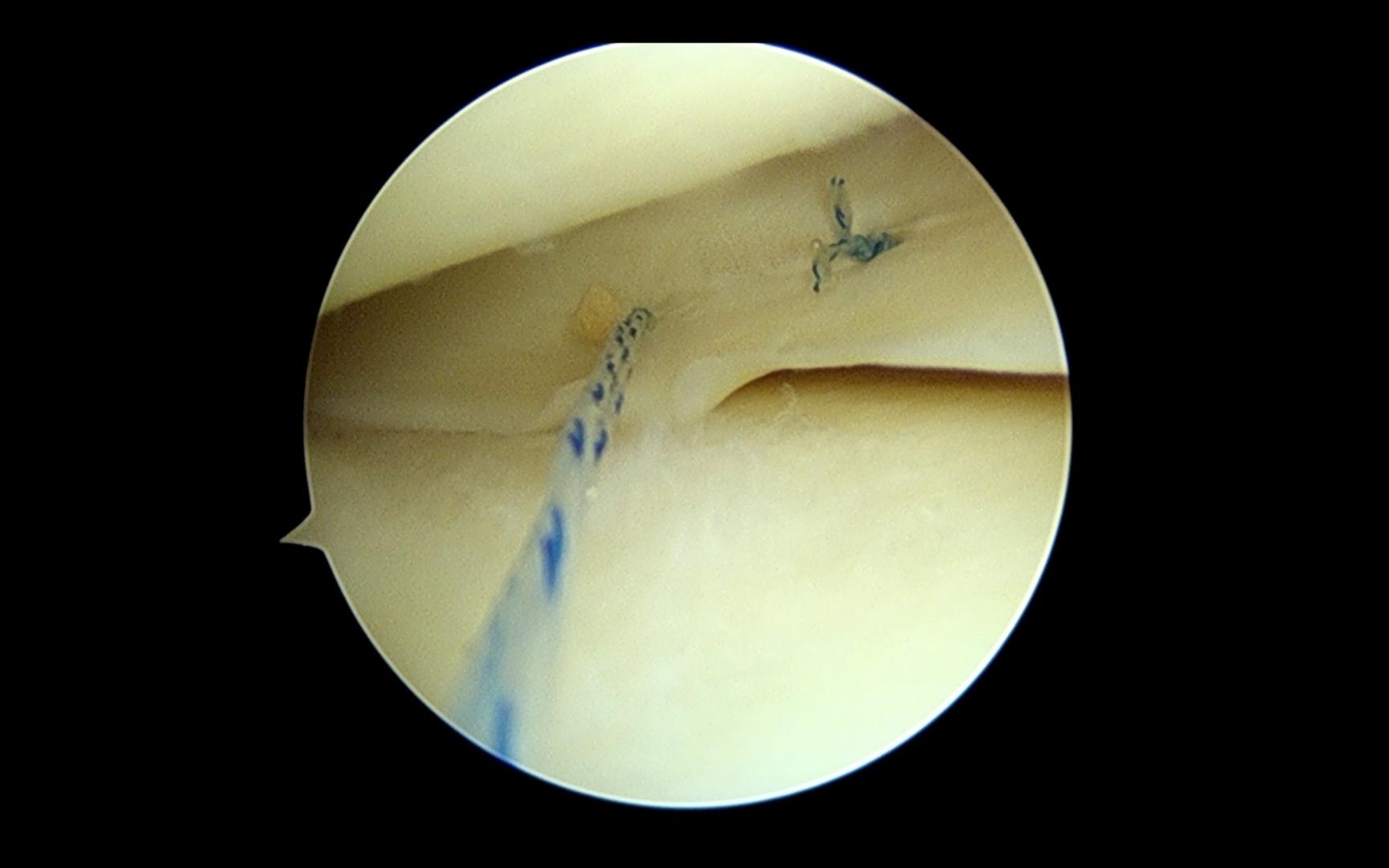 Image: Arthroscopic image of a meniscus repair