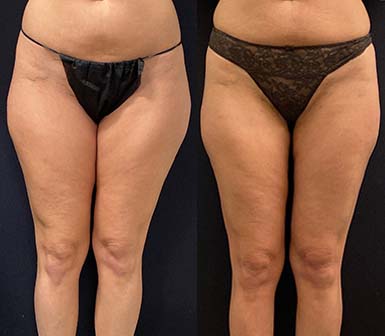 How to Get Rid of Inner Thigh Loose Skin Without Surgery or Exercise 