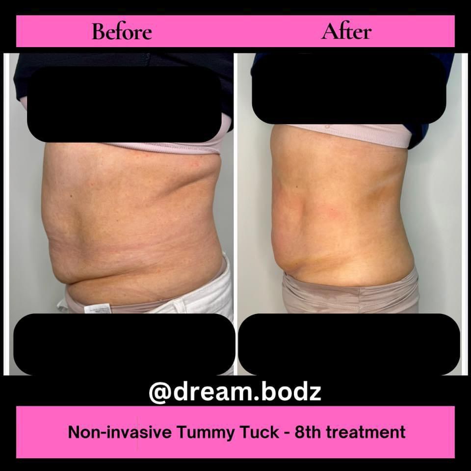 abdomen transformation before and after photo